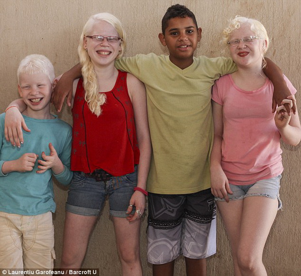 Как люди рождаются альбиносами. Семья альбиносов. Темнокожий альбинос.