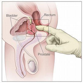 prostate-dre