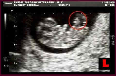 majk-dzekson-viden-na-ultrazvuk1